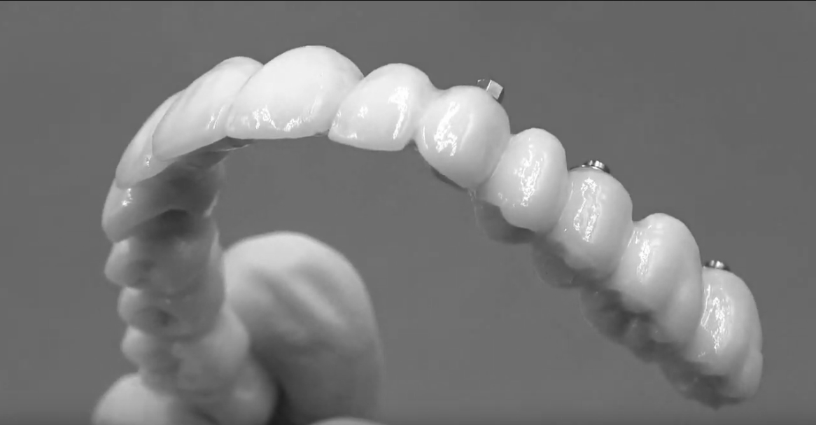 Dental Implant Cost Fort Lauderdale
