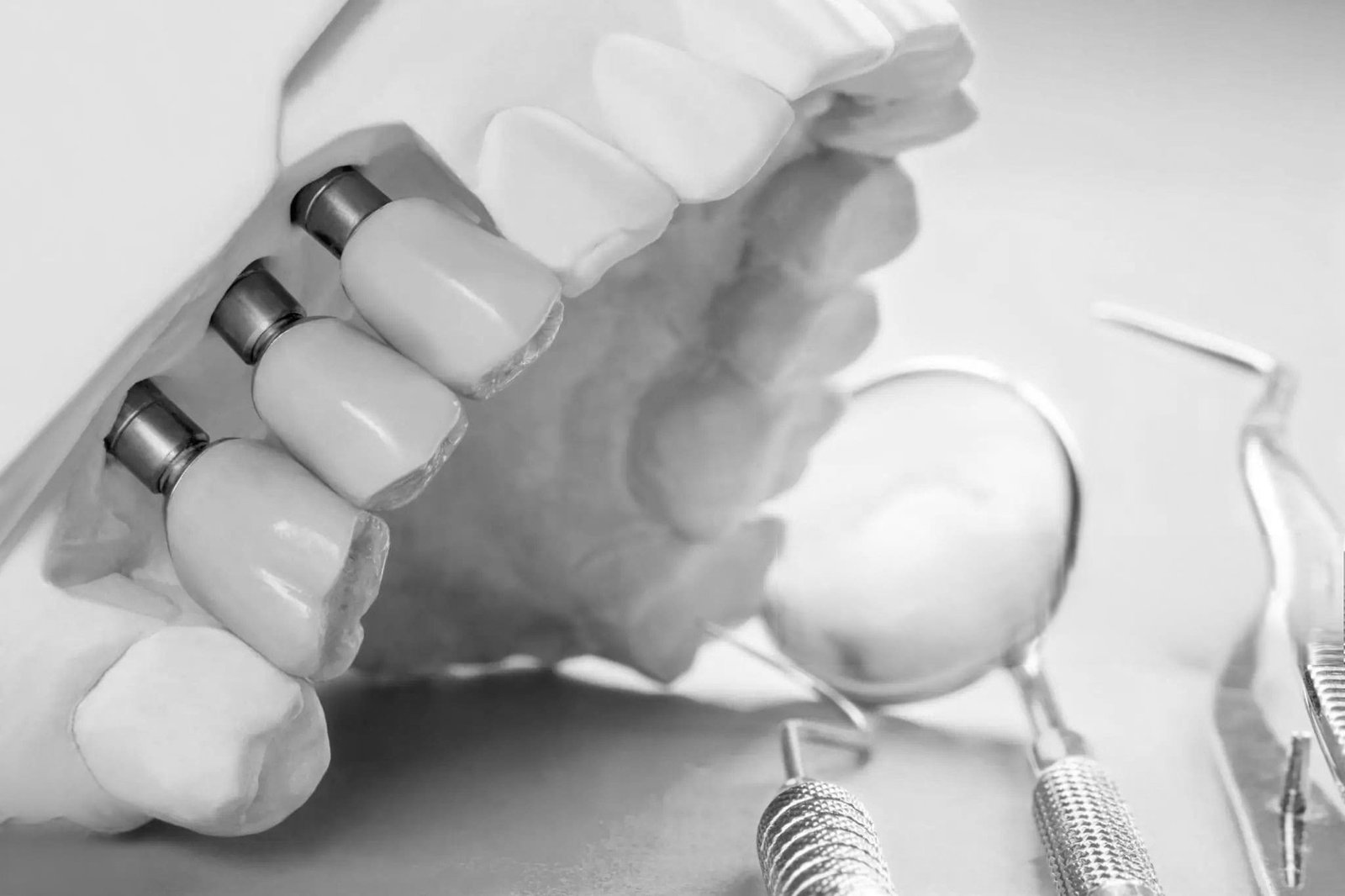 Everything You Need to Know About Dental Implants in NYC