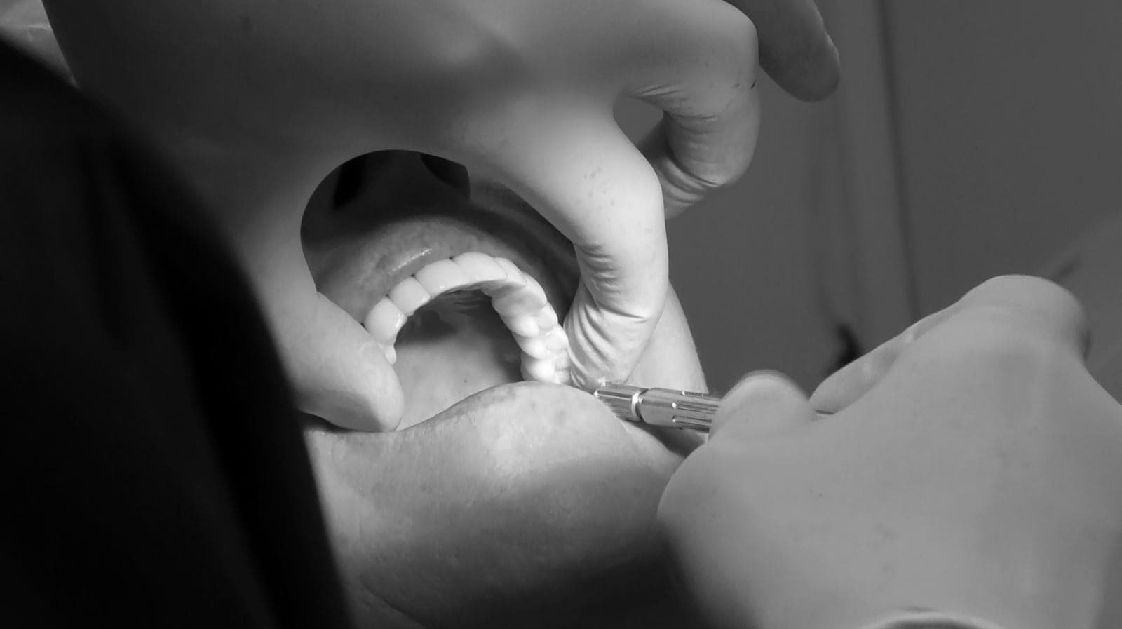 Dental Implant Cost West Samoset